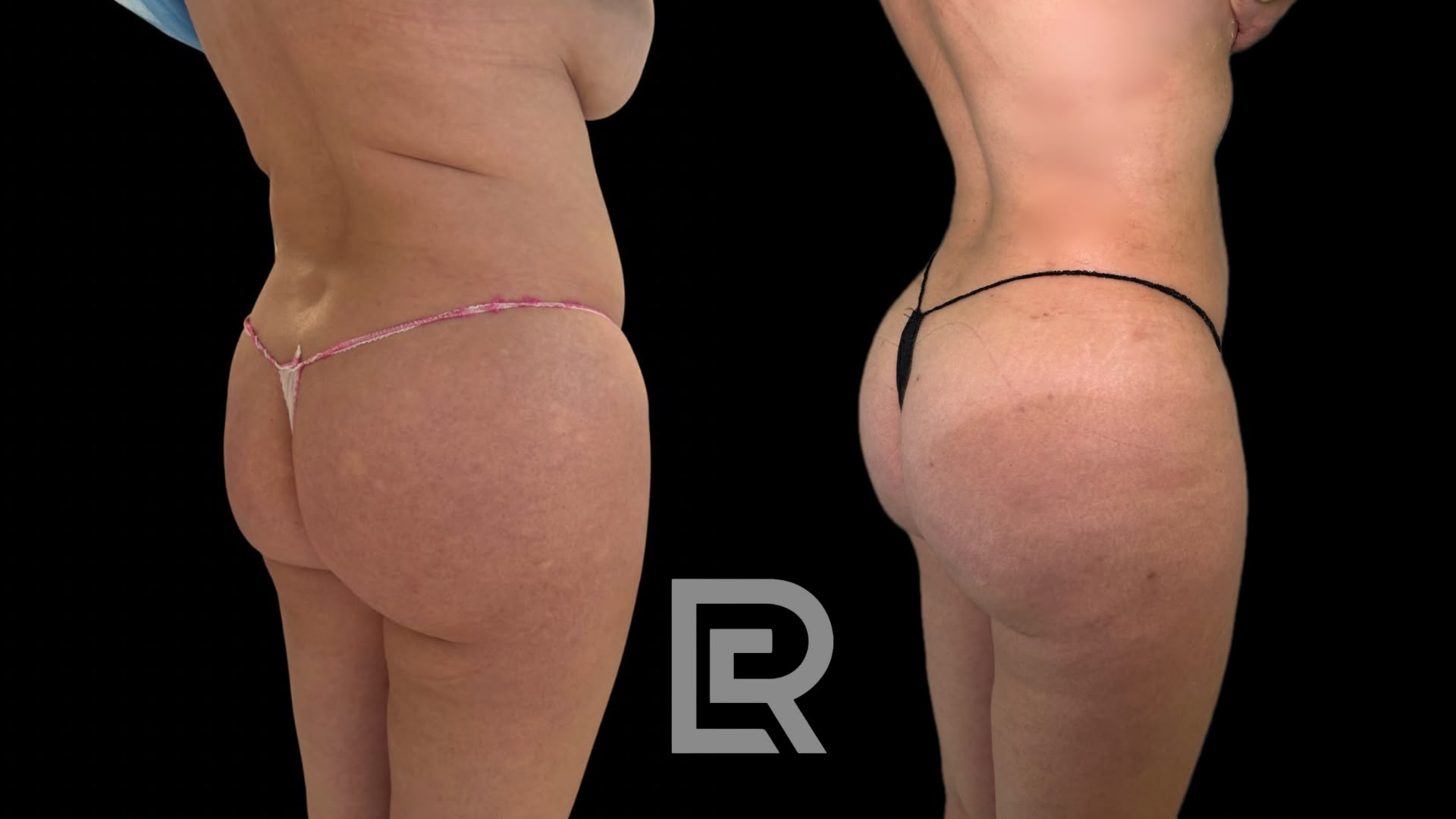 Lipolaser sin cirugía